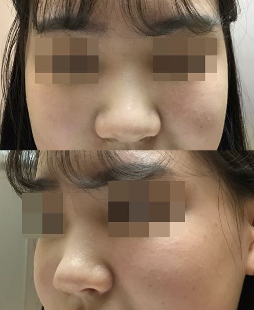 수술전 (1)-vert22.jpg