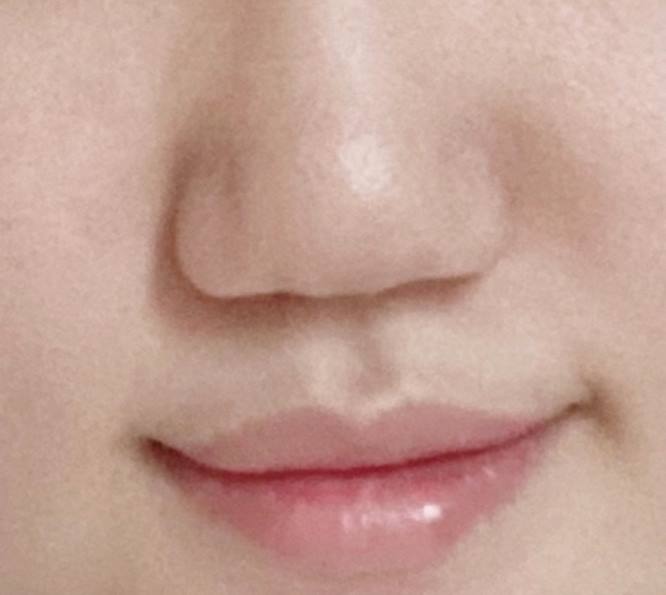수술전 (1).jpg