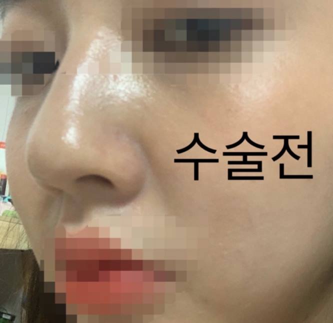 수술전 (1).jpg