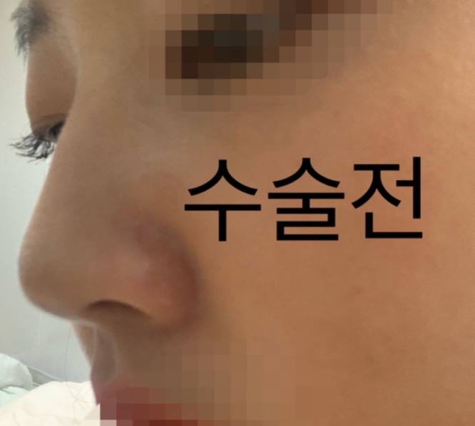수술전 (3).jpg