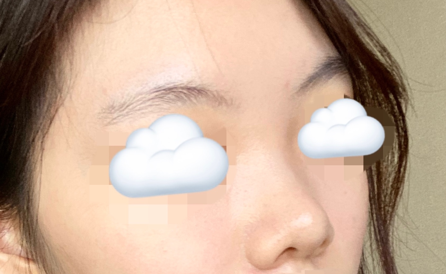 수술전 (4).jpg