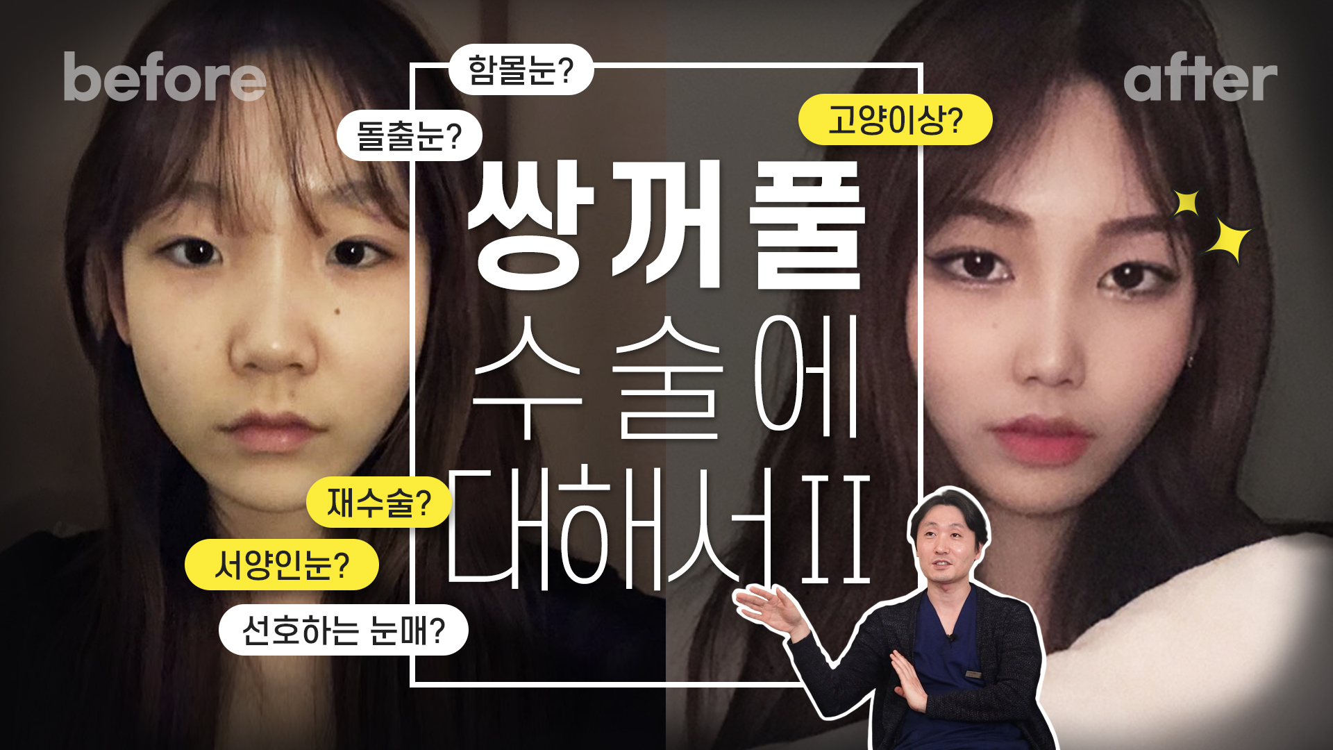 [✔눈 성형이란? 궁금증 두 번째편] 눈 성형 지식 - 고양이 상,강아지 상,눈의 형태,선호하는 눈매,재수술