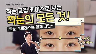 짝눈 교정 │ 실제 케이스로 알아보는 짝눈의 모든 것! 짝눈 스트레스.. 이 영상 하나면 탈출각!!!