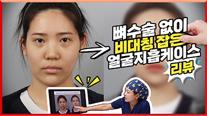 맥스브이리프팅(얼굴지방흡입) 해도 ooo 못맞추면 무슨소용?