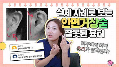 실제사례로 알아보는 안면거상술 잘못된 흉터ㅣ흉터 개선 방법까지 모두 알려드려요