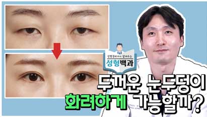 실제 수술사례를 통해 알아보는 눈성형 모든 것 (절개눈매교정,앞트임)