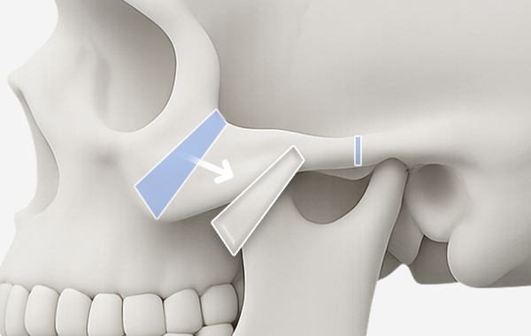 광대축소술 수술방법