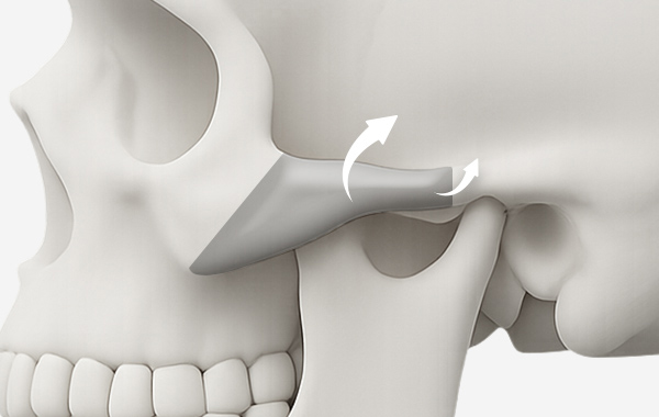 광대축소술 수술방법