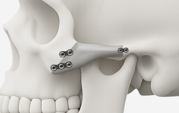 광대축소술 수술방법