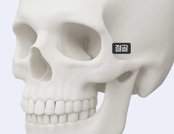 1세대 - 비고정식 광대축소(퀵광대)