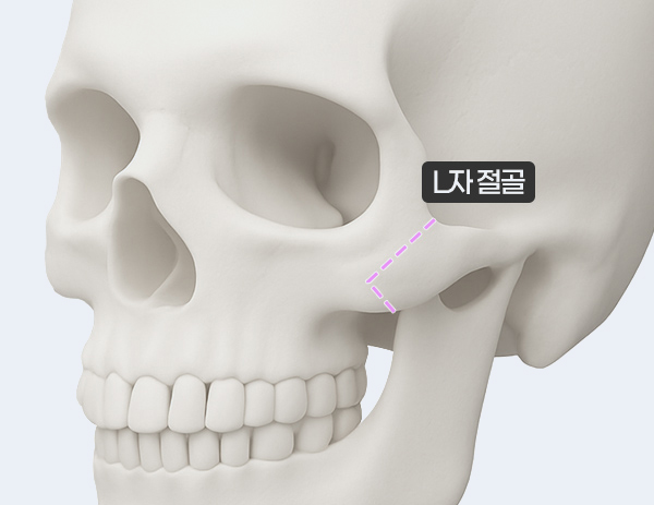 2세대 - L자 절골