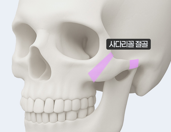 4세대 - 3D 광대회전술