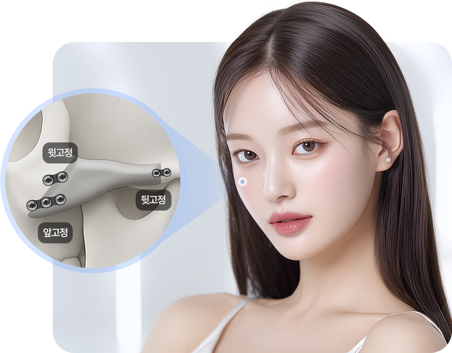 미국산 티타늄 플레이트로 단단한 3중 고정