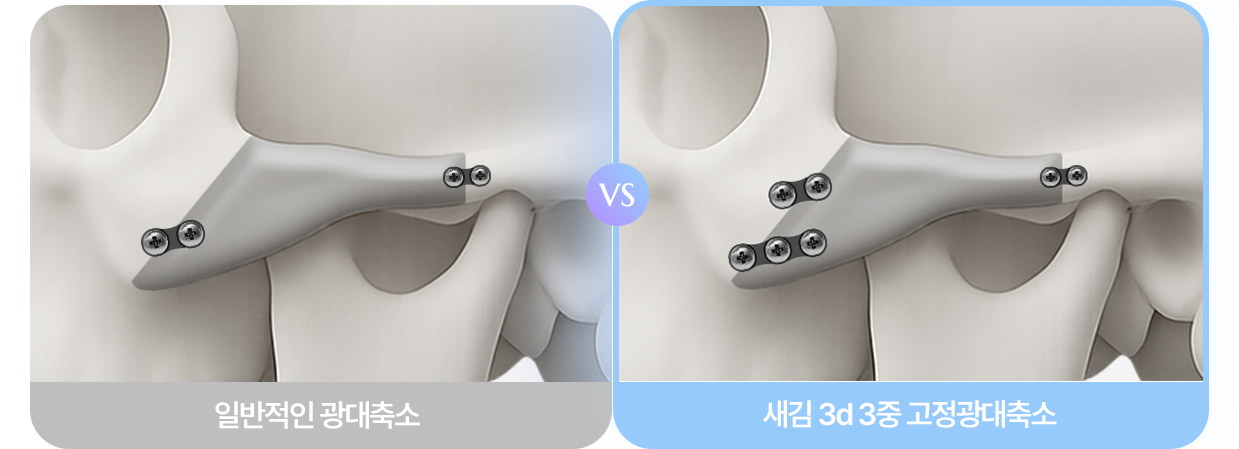 광대축소술 비교