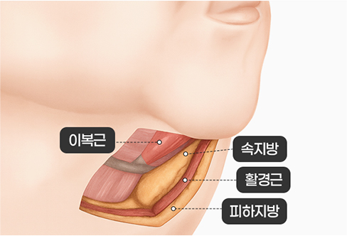 함께하면 더 좋은 수술 - 이중턱 근육묶기