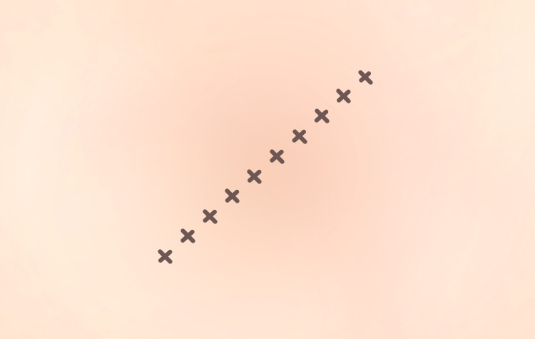 흉터-방추형-절제술4