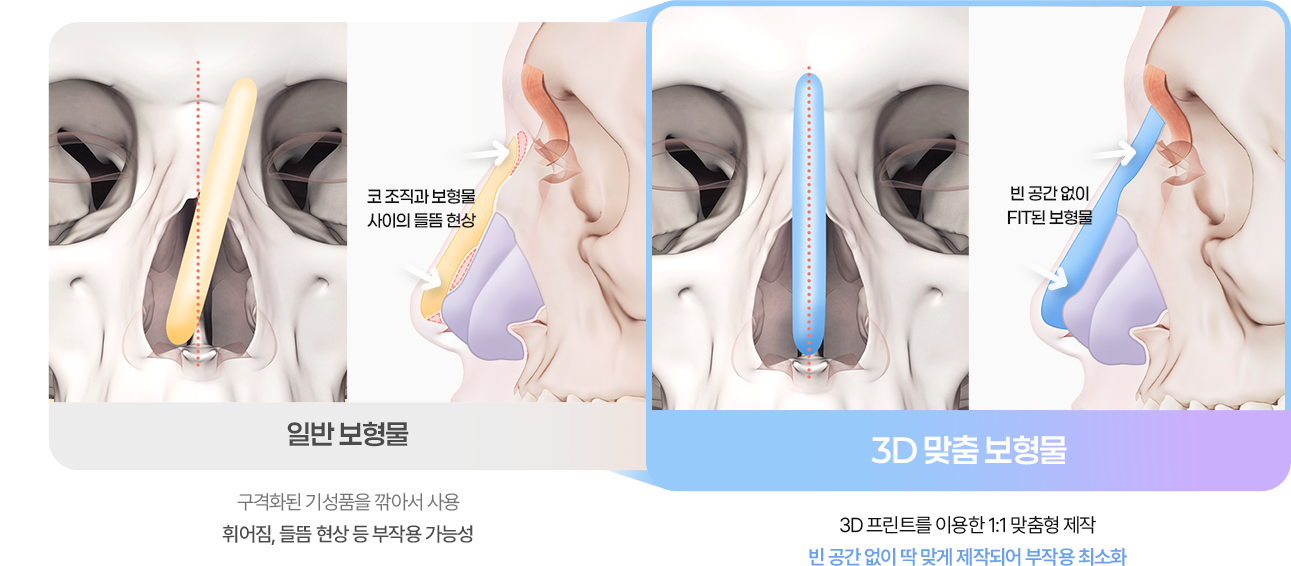 3D 맞춤 보형물 비교