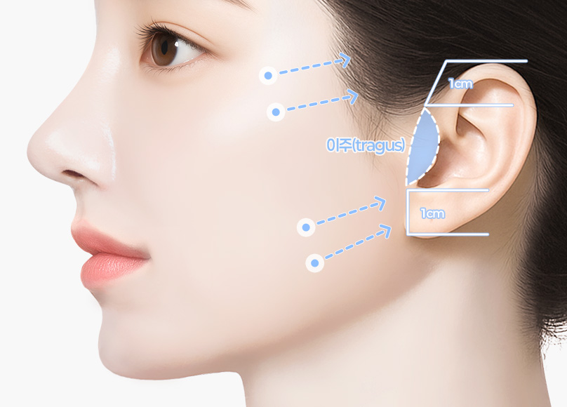 새김성형외과의 맞춤형 리프팅 01