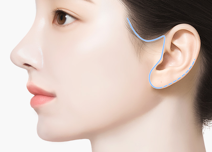 새김성형외과의 맞춤형 리프팅 02