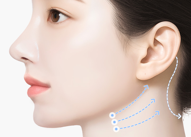 새김성형외과의 맞춤형 리프팅 03