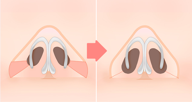 콧볼축소 수술 방법 02 콧볼 줄여주기