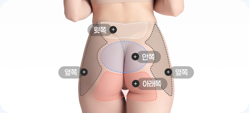 엉덩이지방이식 시술 부위