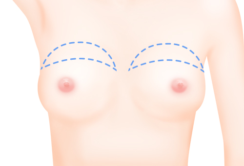 가슴 윗부분 확대