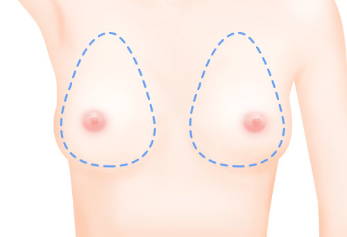 보형물 제거 후 시술