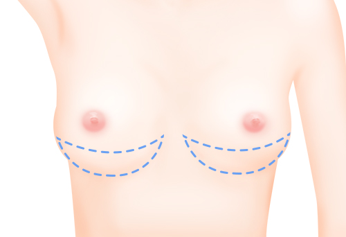 가슴 아랫부분 확대