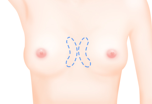 가슴 안쪽 확대