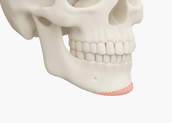 무턱보형물 수술방법 1. 입안 절개 및 골막 분리