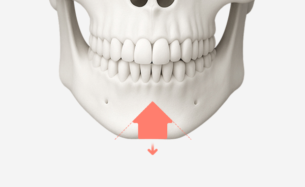 턱끝수술 ㅅ절골법 수술방법