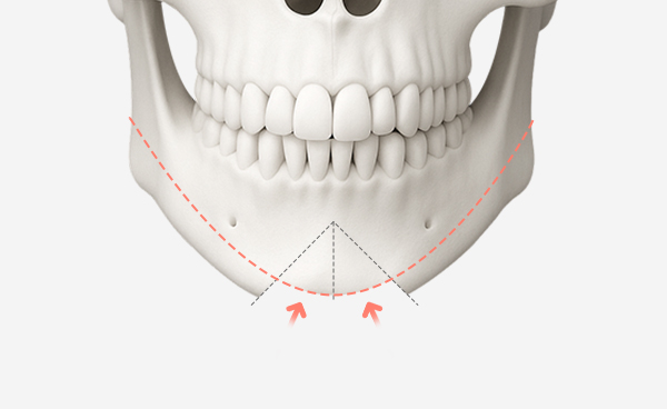 턱끝수술 ㅅ절골법 수술방법
