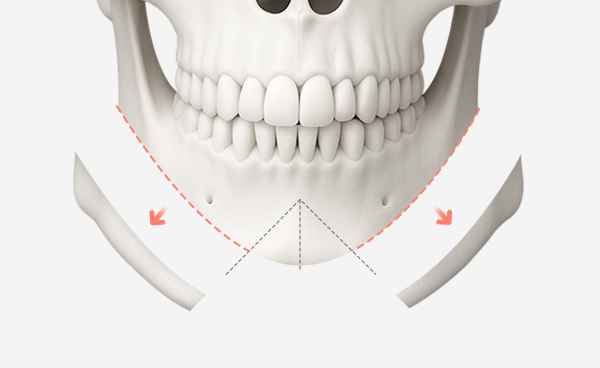 턱끝수술 ㅅ절골법 수술방법