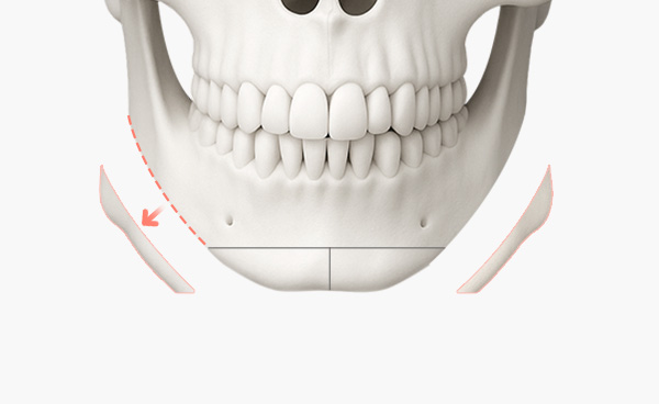 턱끝수술 T절골법 수술방법