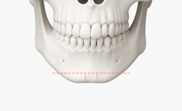 턱끝수술 T절골법 수술방법