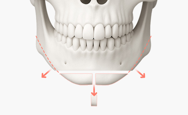 턱끝수술 T절골법 수술방법
