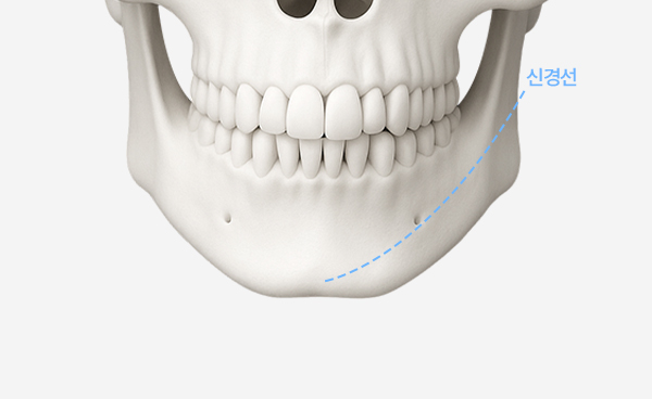 턱끝수술 V절골법 수술방법
