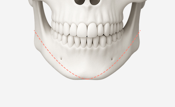 턱끝수술 V절골법 수술방법