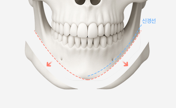턱끝수술 V절골법 수술방법