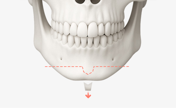 턱끝수술 변형T절골법 수술방법