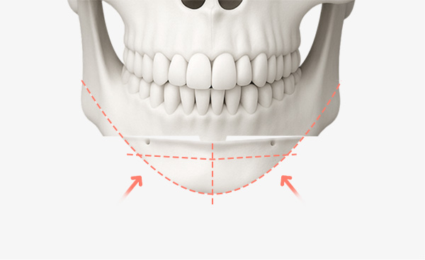 턱끝수술 변형T절골법 수술방법