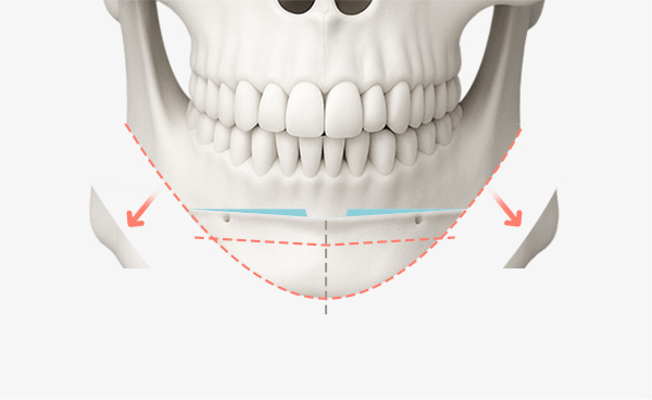 턱끝수술 변형T절골법 수술방법