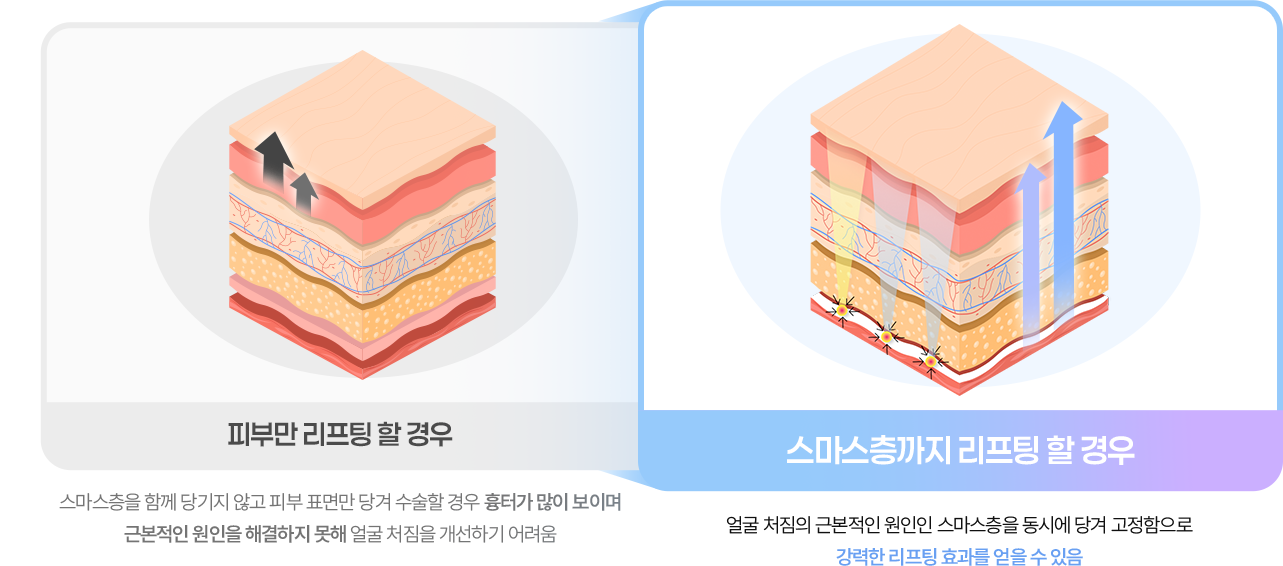 피부만 리프팅 할 경우 vs 스마스층까지 리프팅 할 경우