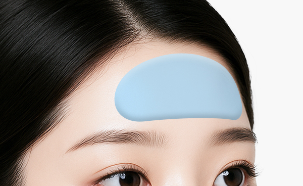 이마보형물 수술방법 2.두피 가르마 방향을 따라 미세절개하여 맞춤 보형물을 삽입