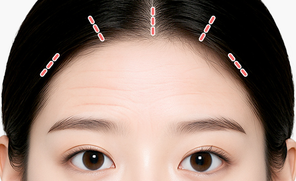 새김 이마거상 수술 방법 step 01