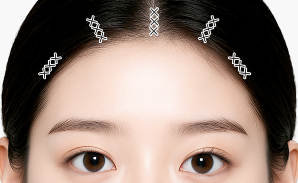 새김 이마거상 수술 방법 step 03