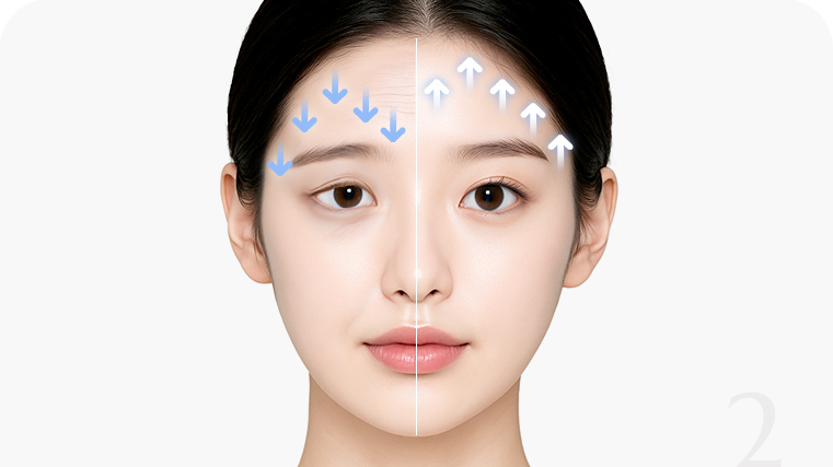 이마주름뿐 아니라 눈매까지 개선