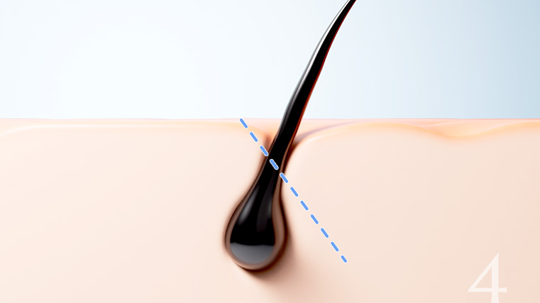 모근 손상을 줄이기 위해 45도 사선절개