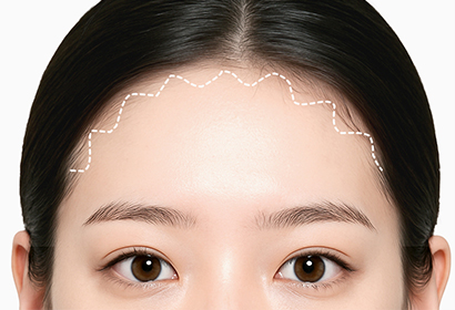 새김 이마축소 수술 방법 01